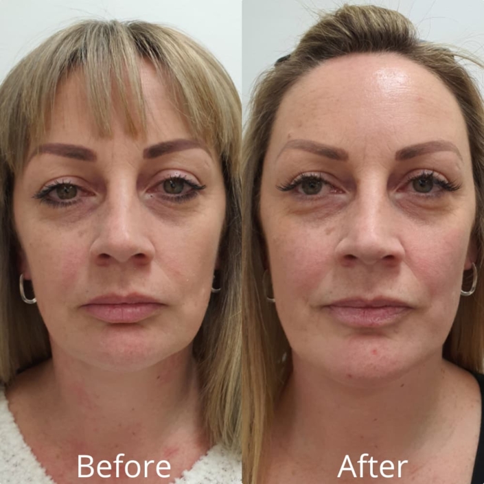 before and after pdo thread lift before and after pdo thread lift