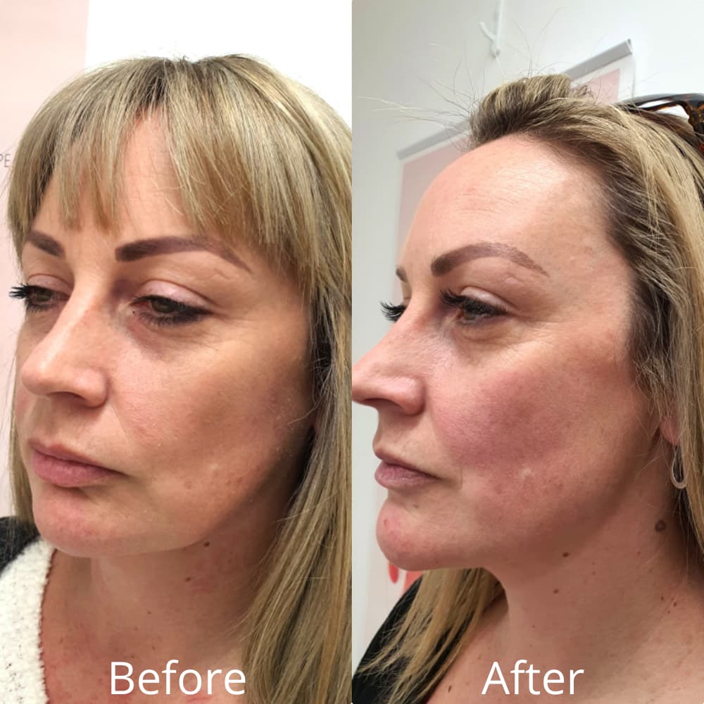 pdo thread lift jawline before and after pdo thread lift jawline before and after